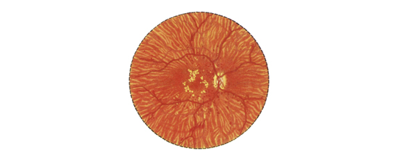 Picture of diabetic retinopathy eye